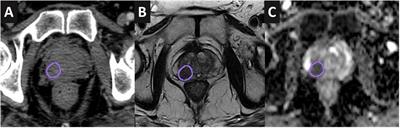 Proton versus photon therapy for high-risk prostate cancer with dose escalation of dominant intraprostatic lesions: a preliminary planning study